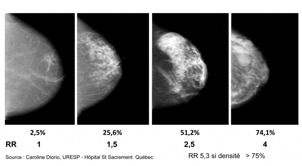 DensitÄ Mammaire 1