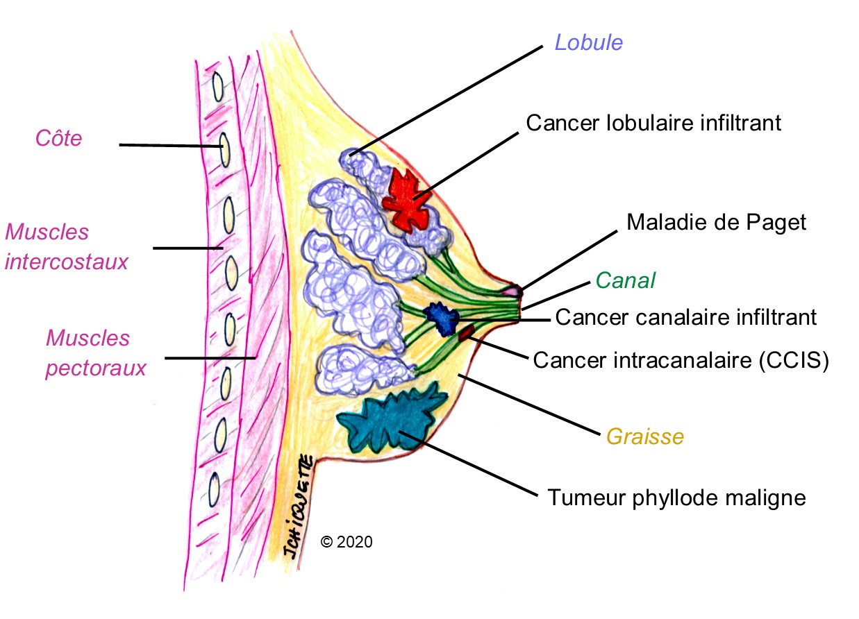 Anatomie du sein - Cancer du sein